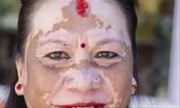விட்டிலிகோ என்றால் என்ன?